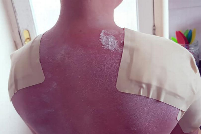  Nathan Herbert, 11, was left severely burned after he failed to put on suncream while at the beach in the heatwave