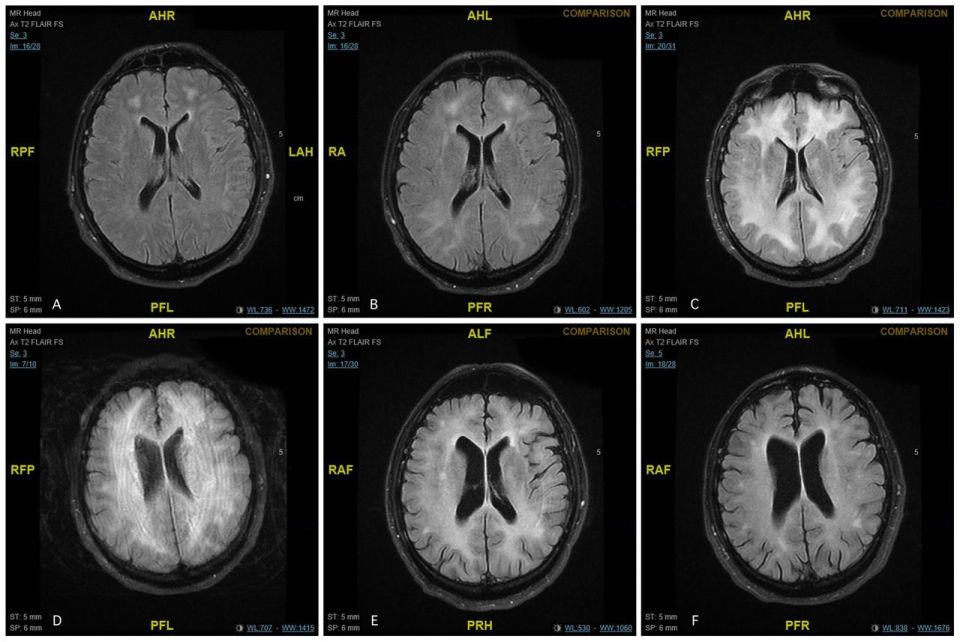  The MRI scans of a regular cocaine user reveal the damage the drug can cause over time. The unnamed patient was diagnosed with a rare condition called cocaine-induced toxic leucoencephalopathy after regularly abusing the Class A