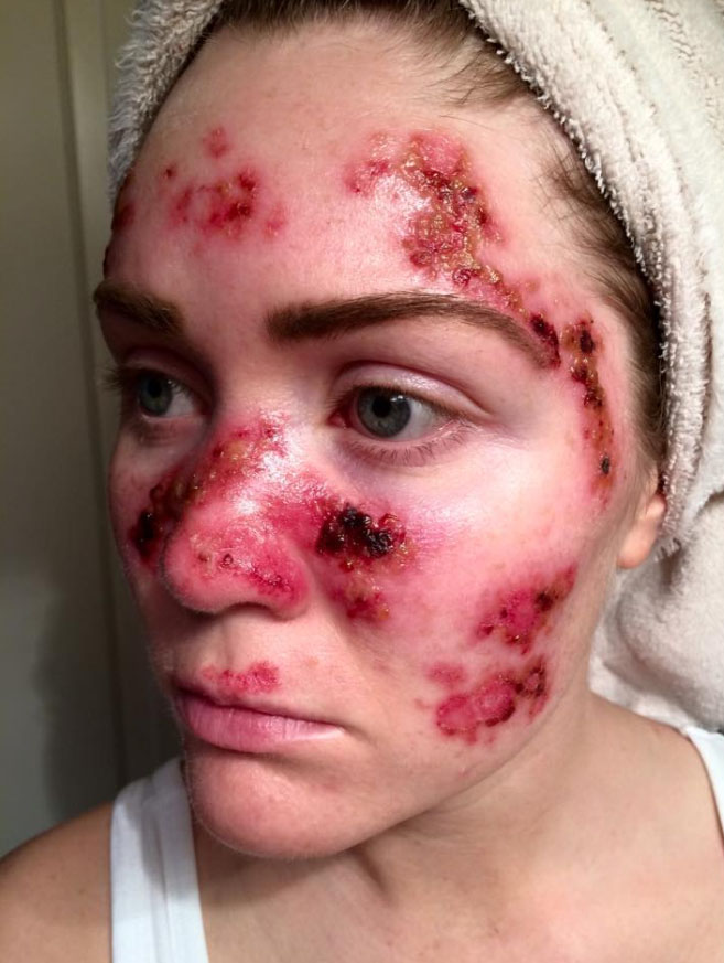  Tawny Willoughby shared this shocking image of herself online to show the devastation of skin cancer