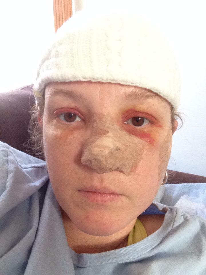  Lisa Pace has had almost 90 surgeries to remove various patches of skin cancer