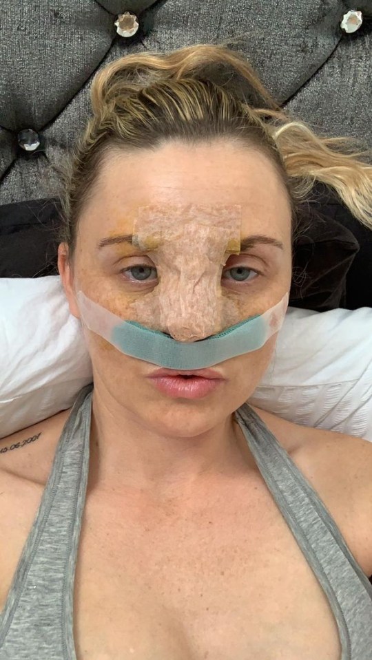 Carla, 37, got her nose job on the NHS after pretending to have mental health problems