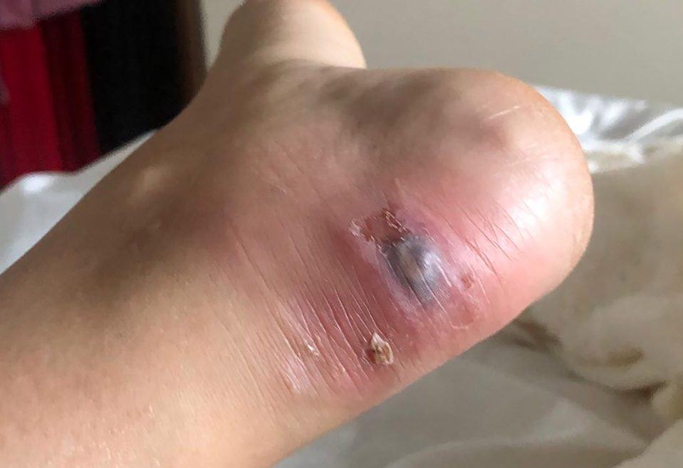  Gemma's heel in the evening after she noticed the shoes were rubbing her heel and causing pain