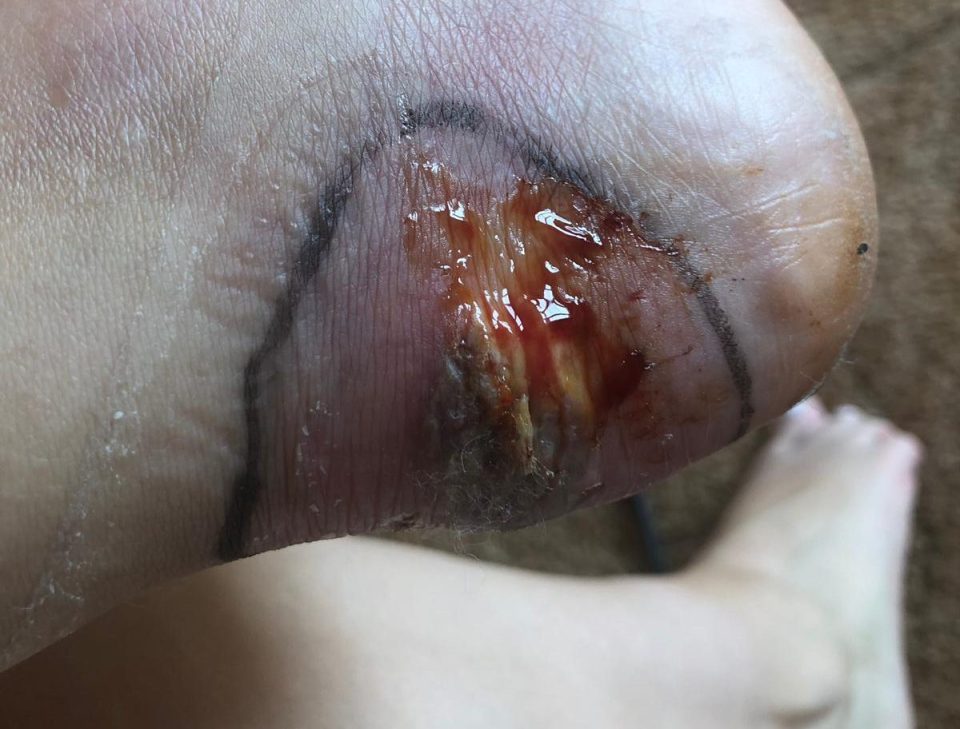  She needed fluid drained from the blister to catch the infection before it spread