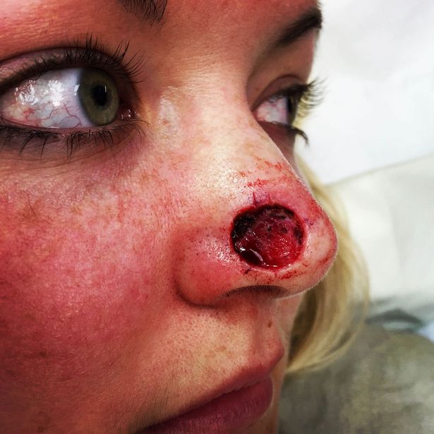  Jade Thrasher was left with a huge hole in her nose after developing skin cancer