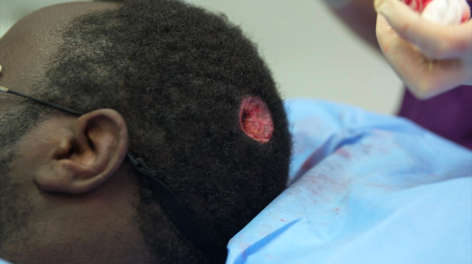  The wound that was left on Andrew's head after it was removed