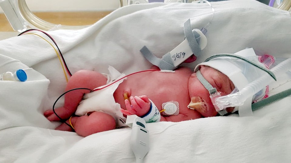 The babies were born prematurely at just 30 weeks old following the dangerous rupture