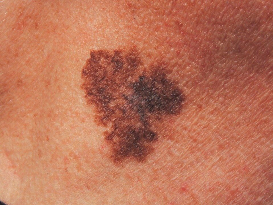 A Lentigo maligna melanoma mole on the neck