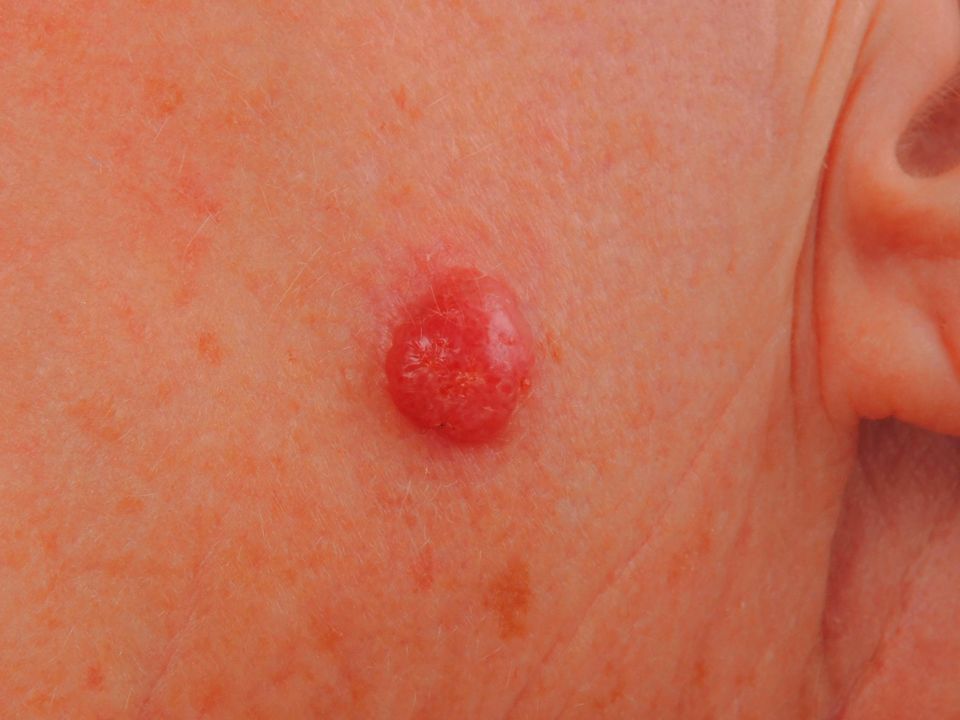 A nodular melanoma which is one of the fastest-growing types