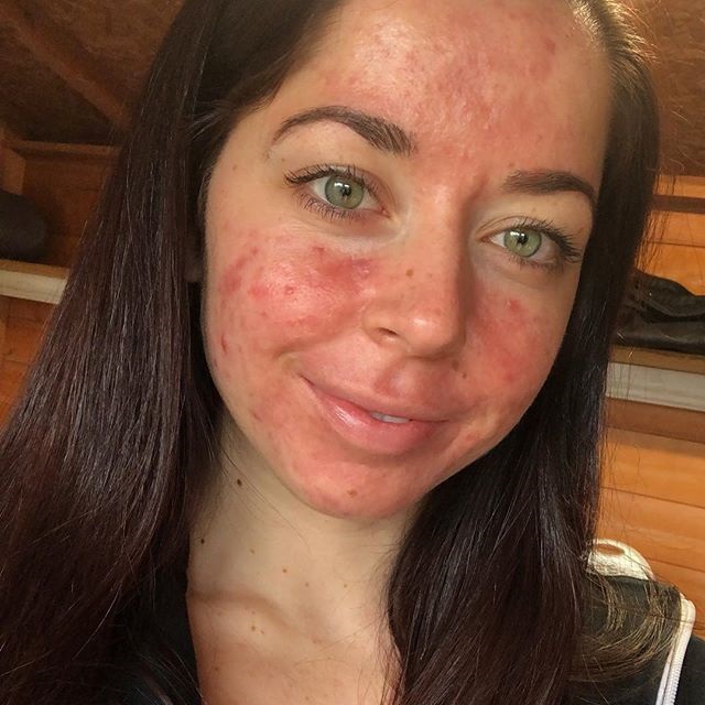  Emily Keel, 25, from Portsmouth, was first diagnosed with cystic acne aged 12