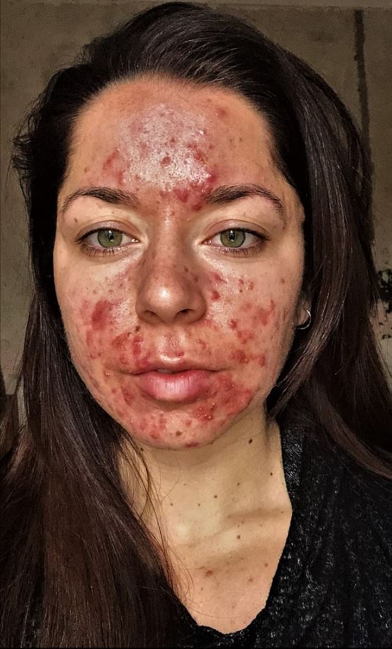  The acne left her with horrific boils on her face