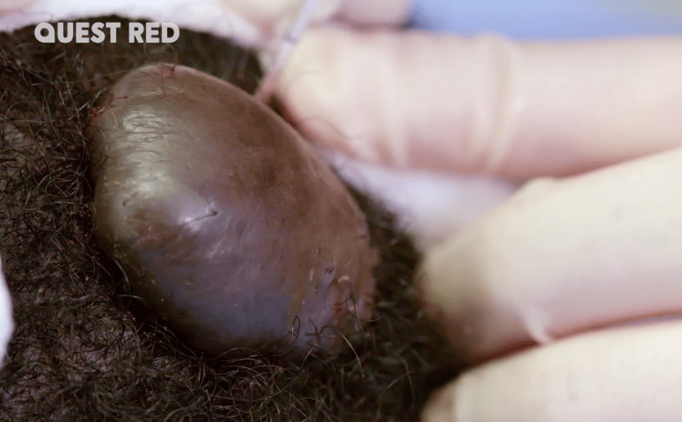  The mushroom-shaped growth on the back of Andrew's head was causing him embarrassment