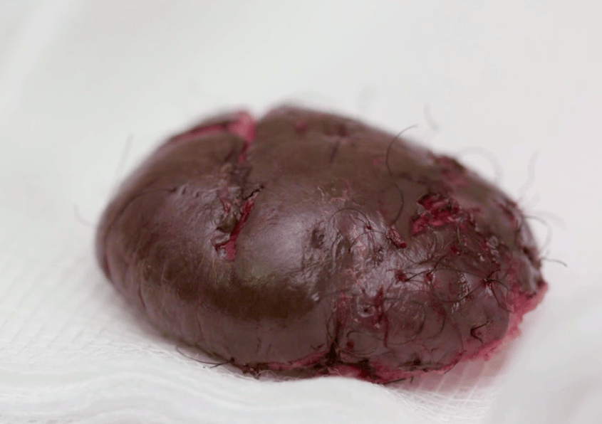  The mushroom-shaped growth sits on a piece of gauze after being removed