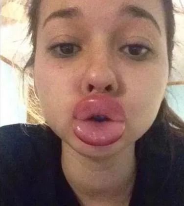 Women shared painful-looking lips online after trying the 'challenge'