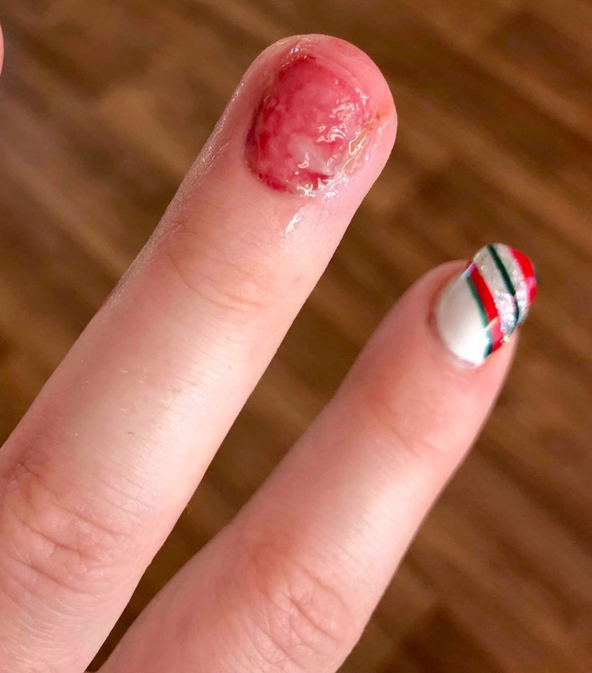  Toni's natural nail was ripped straight off