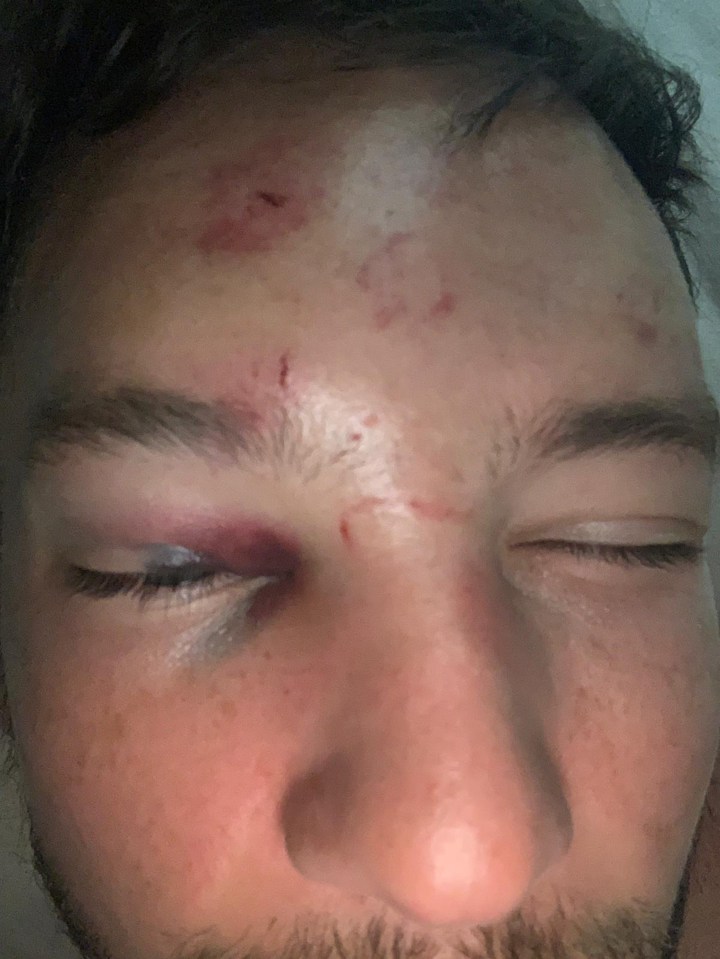 England and Chelsea star Danny Drinkwater, pictured after he was attacked by six thugs outside of a nightclub