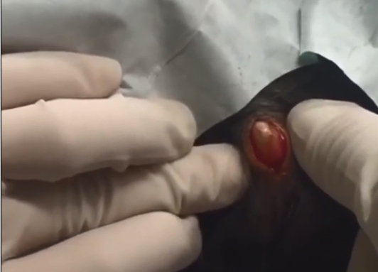  Dr Pimple Popper says this type of cyst is 'fun to pop out'