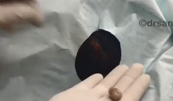  Dr Pimple Popper tries to catch the lump as it pops out the patient's head