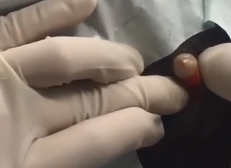  Dr Pimple Popper squeezes a 'lump of gum' from a patient's scalp