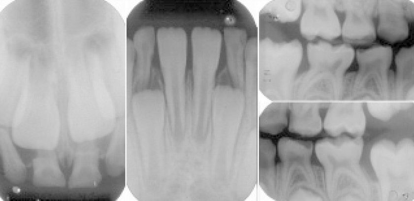  X-rays from the six-year-old show signs of fractures in his primary teeth