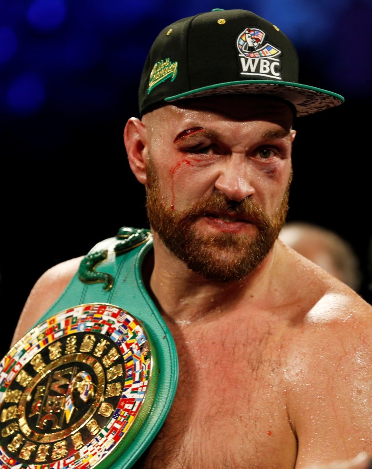 Tyson Fury had a much tougher fight against Otto Wallin than experts predicted - and needed 47 stitches after a cut that nearly cost him the fight