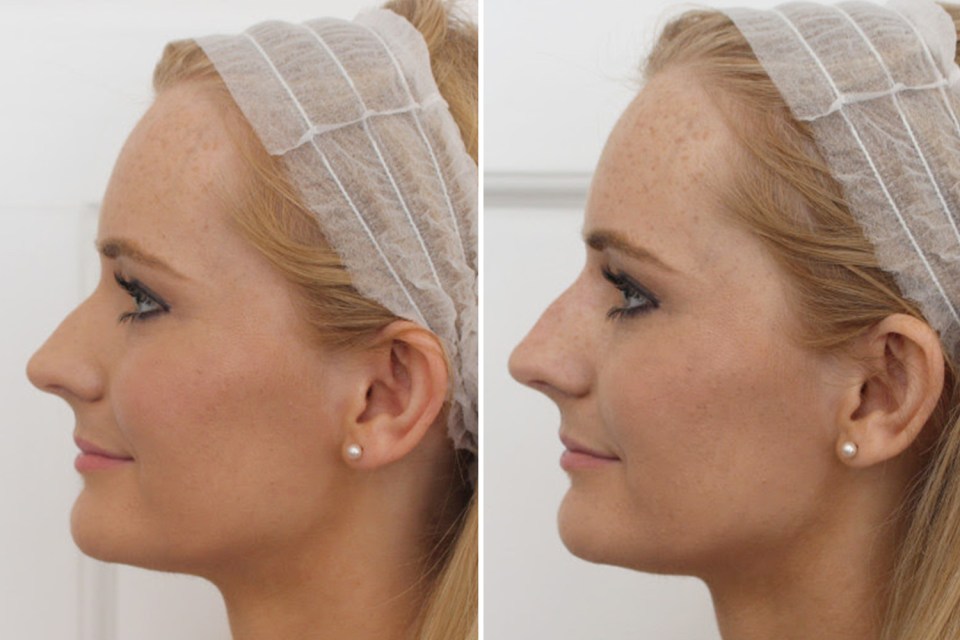 I went to have a non-surgical liquid nose job on my lunch break to understand more about the procedure – but the results were very subtle (left: before, right: after)