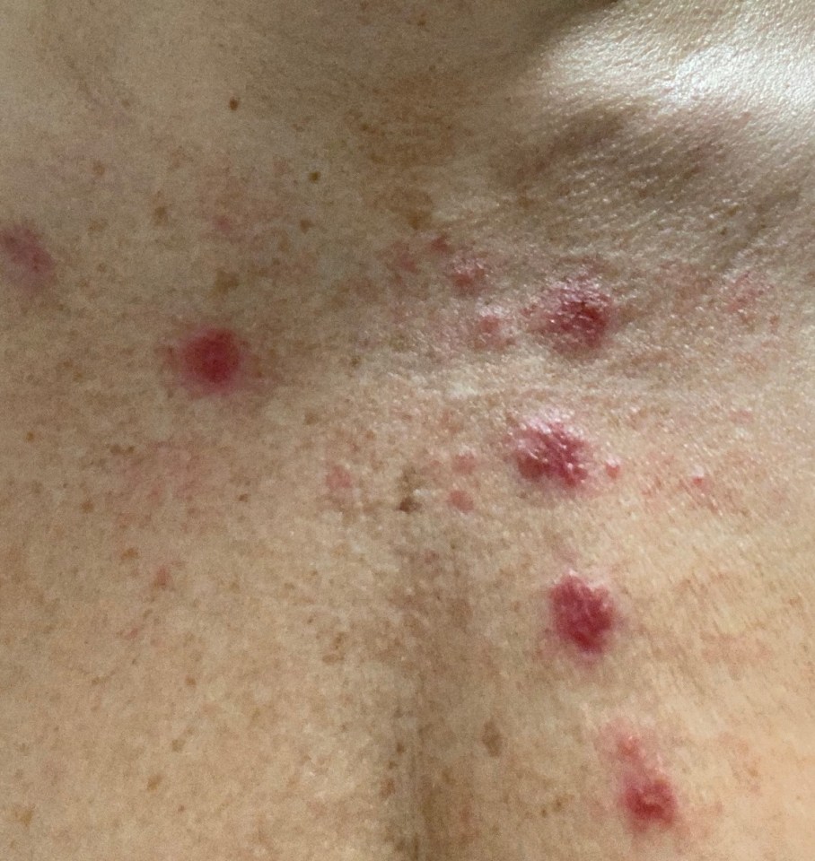 Lisa noticed a series of raised freckles on her chest which were sore to touch – but her GP thought it was psoriasis