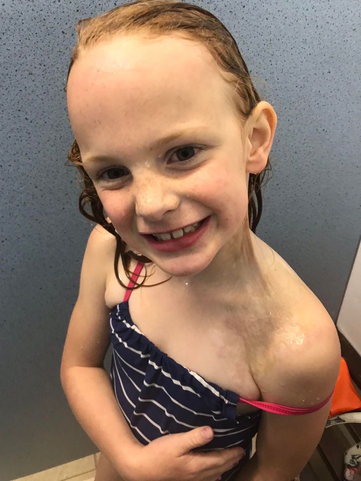  Maisie was injured by a firework in 2016 - pictured are her scars today