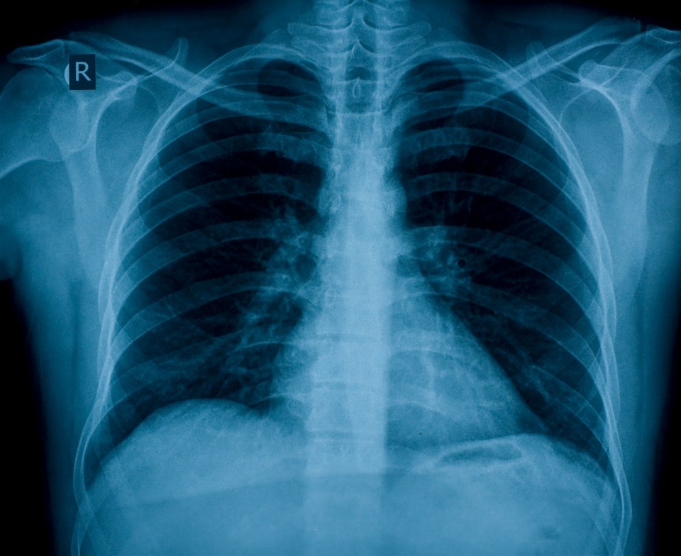  Chest X-rays are missing nearly a quarter of all cancer cases, experts warn