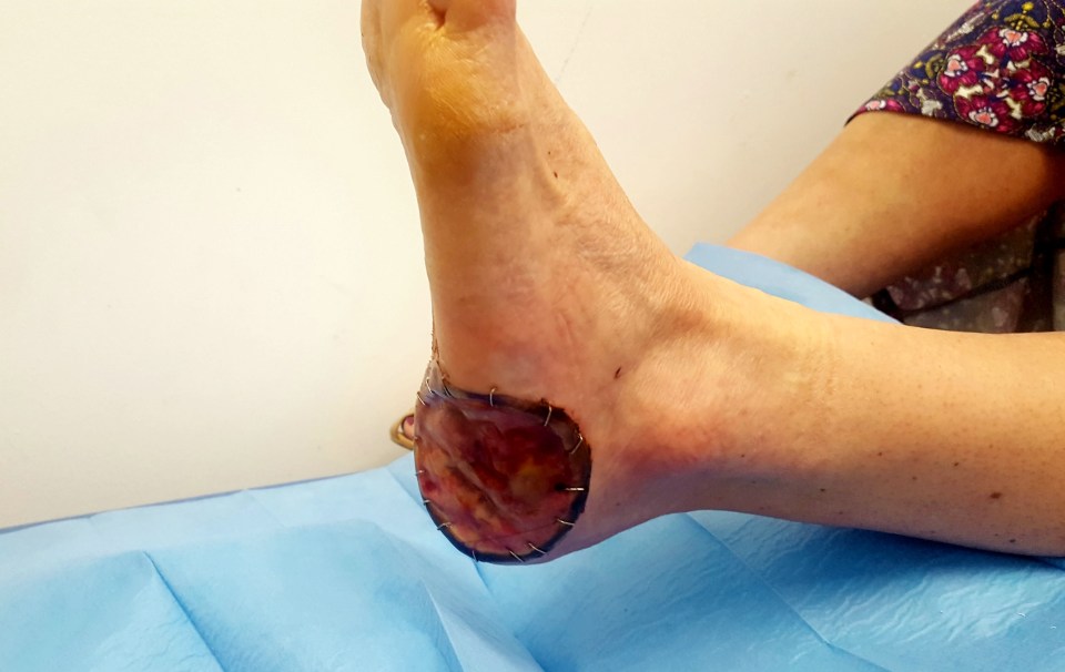 Surgeons removed the growth on the sole of her foot soon after she realised she was unable to walk on it