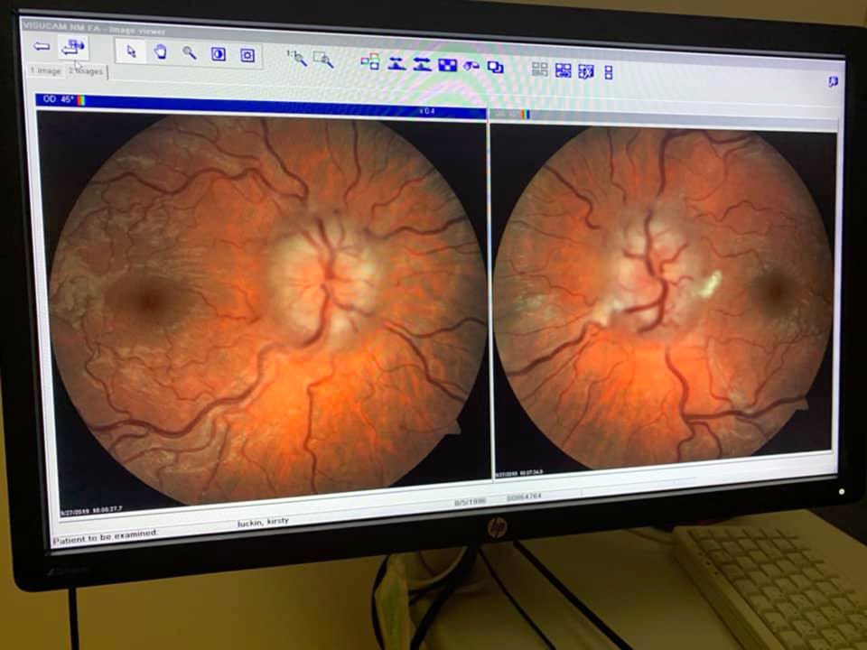  She went to the optician when her vision became blurred and scans showed a fluid build-up behind her eyes, pictured