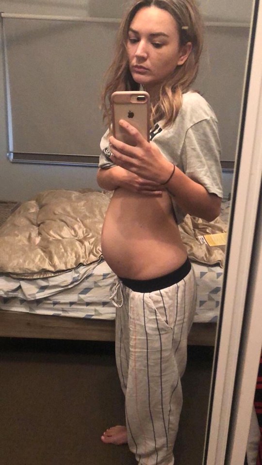  Strangers often assume Claudia is pregnant due to bloating caused by endometriosis