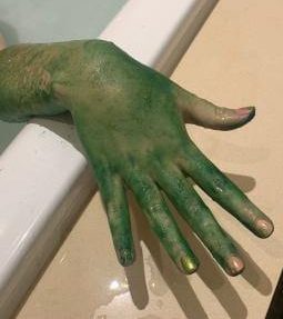  Keri's daughter had green skin for THREE days after the mishap