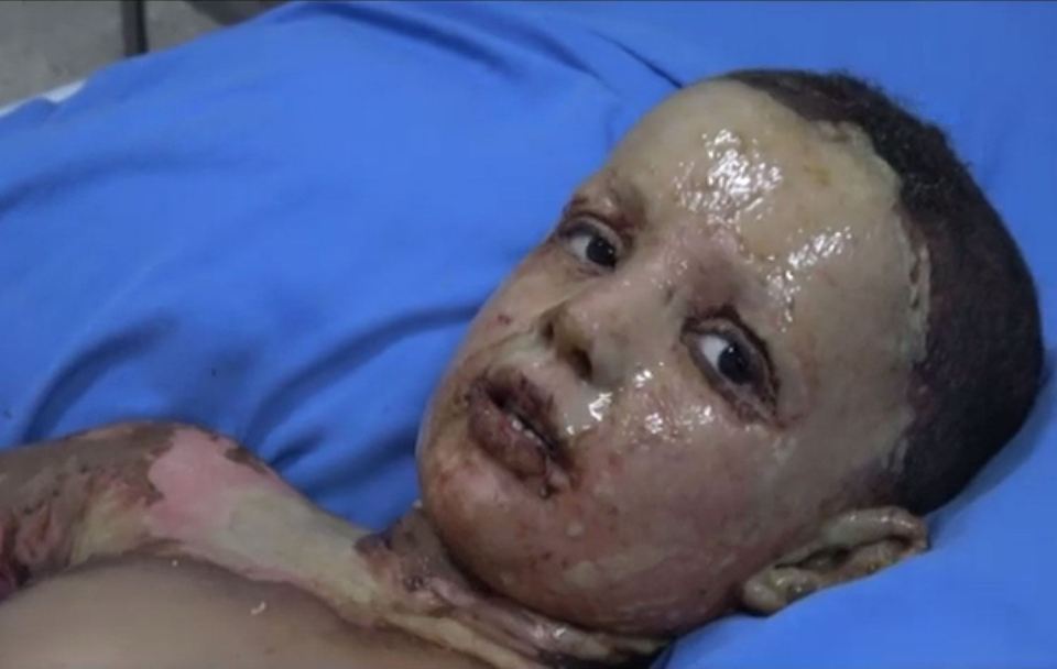 The horrors of war… A child suffering from severely burns lies in a hospital in Hasakah on October 16 