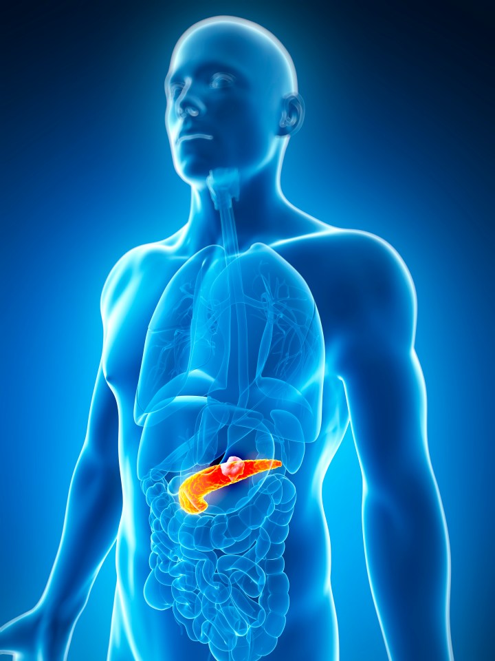  The number of pancreatic cancer cases increased by 130% over the 27-year study period, stock image shows a tumour in the pancreas