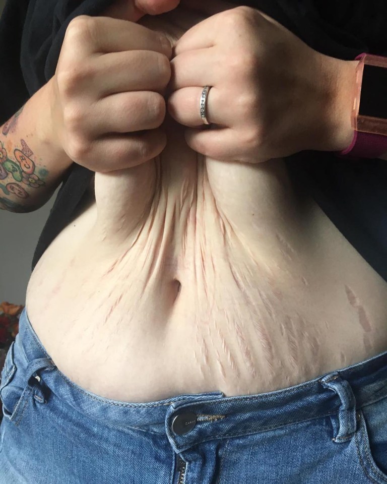  Sarah hasn't had a tummy tuck as she says the loose skin isn't uncomfortable