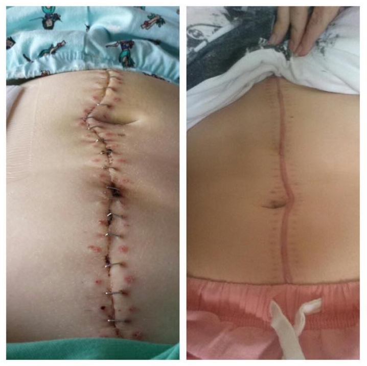  Doctors had to slice through her stomach to save her, leaving her with 40 staples in her body