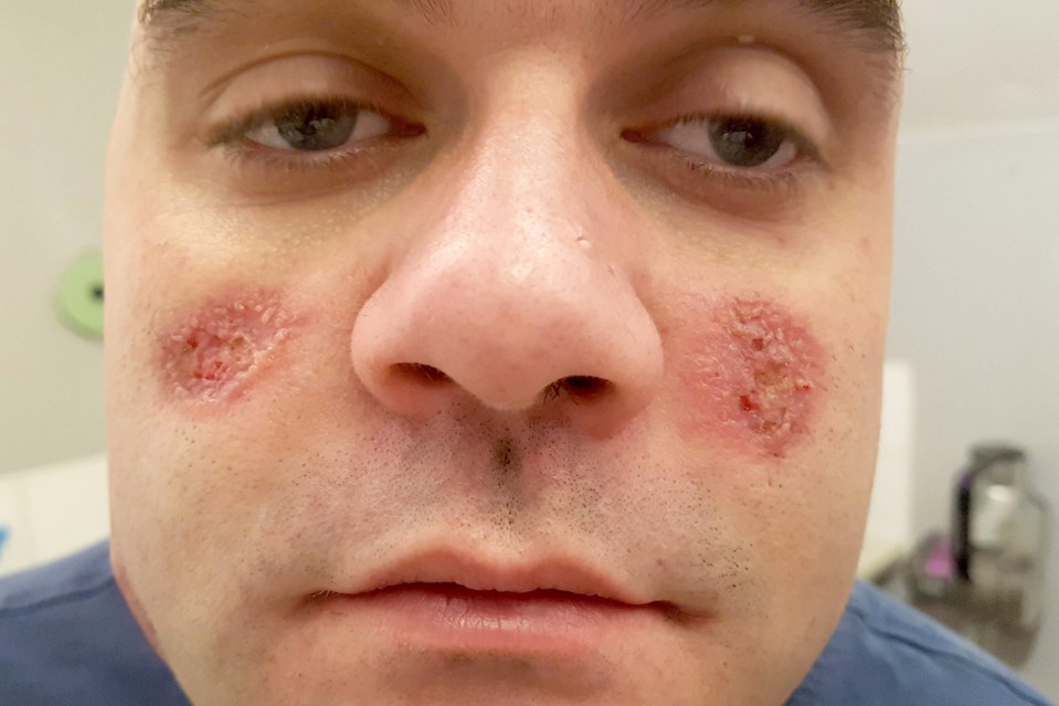 The ulcers on Steve's face caused by pyoderma gangrenosum