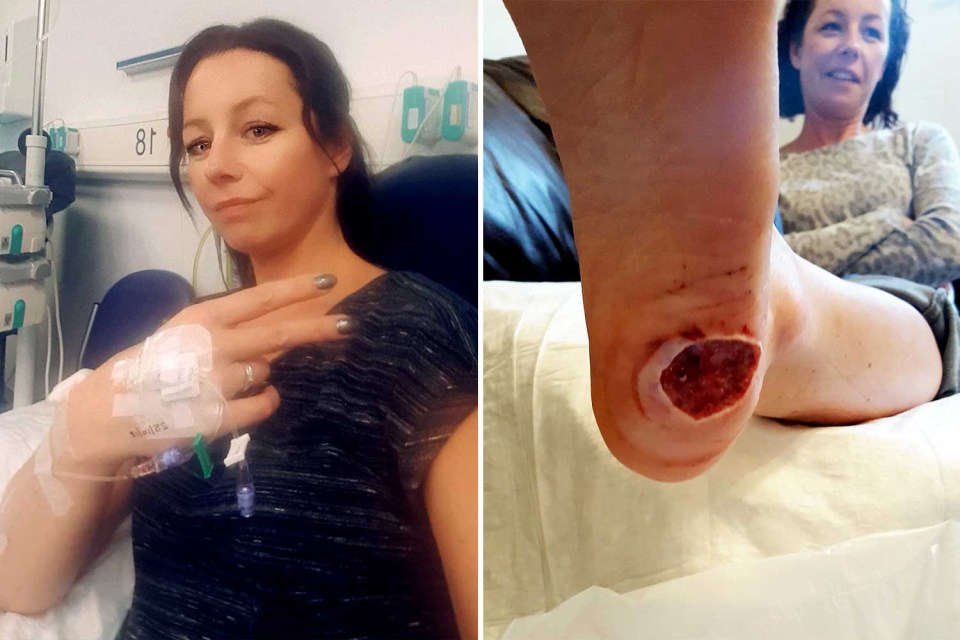 Rachel Solvason, 40, in hospital after learning what she thought was a verruca on her foot was actually skin cancer