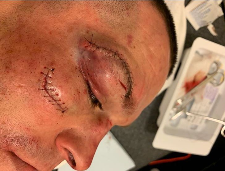  Nate Diaz had to have stitches in two deep cuts above and below his right eye