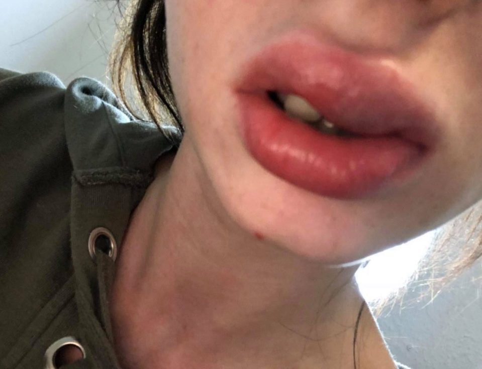  Bethany saw her lips swell after having fillers