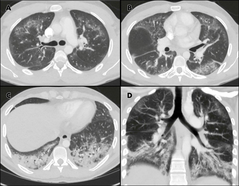  The man had been suffering shortness of breath, a cough, chest pain and fever for a week because of a build-up of vaping oils and fats in his lungs