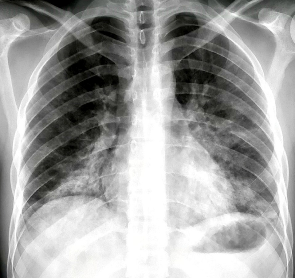  This CT scan of a 24-year-old with a history of e-cigarette use shows alarming abnormalities in his lungs