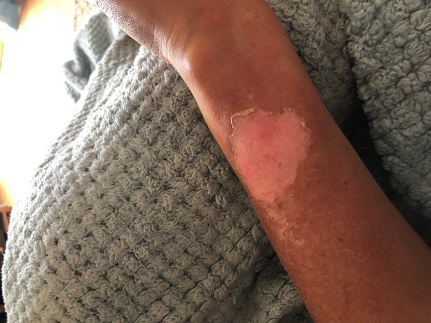  Gemma's skin blistered during chemo