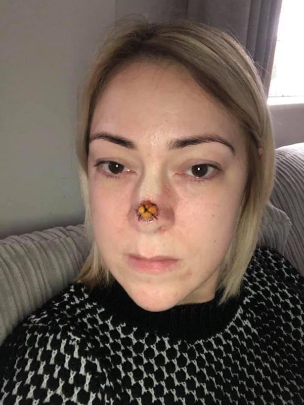 She was shocked when doctors told her it was skin cancer that was eating away at her face – and in ten years would have eaten her whole nose