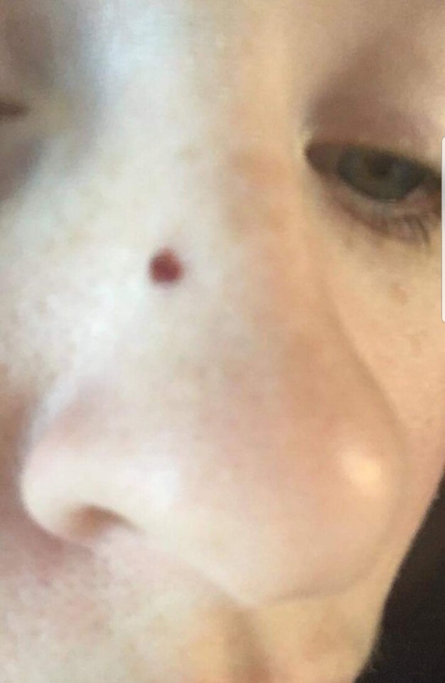  The tiny speck on Katy's nose, which turned out to be basal cell carcinoma