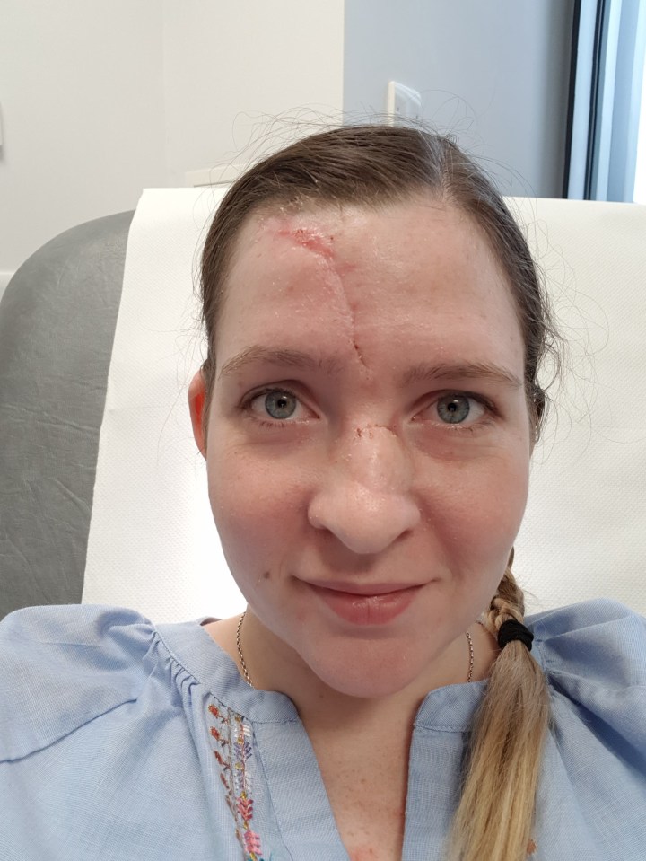  Once the skin had grown enough to cover the wound, Katy returned to hospital this October so doctors could sew the flap back into place and allow her face to heal