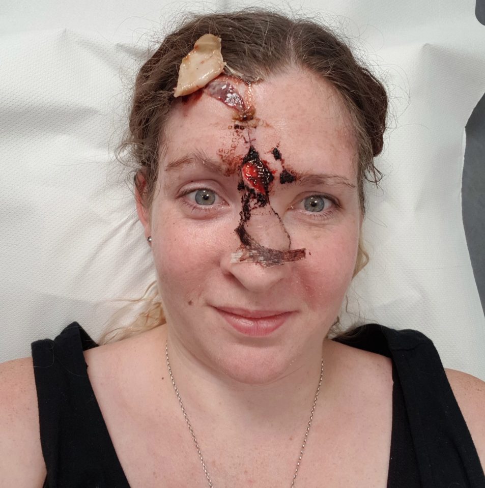  Katy was left with a huge wound down her face after discovering skin cancer on her nose