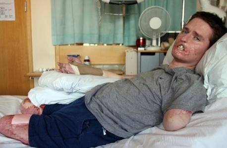  Alex Lewis lost his lips and all four of his limbs to a flesh-eating bug, but 'wouldn't take them back' after achieving his dream