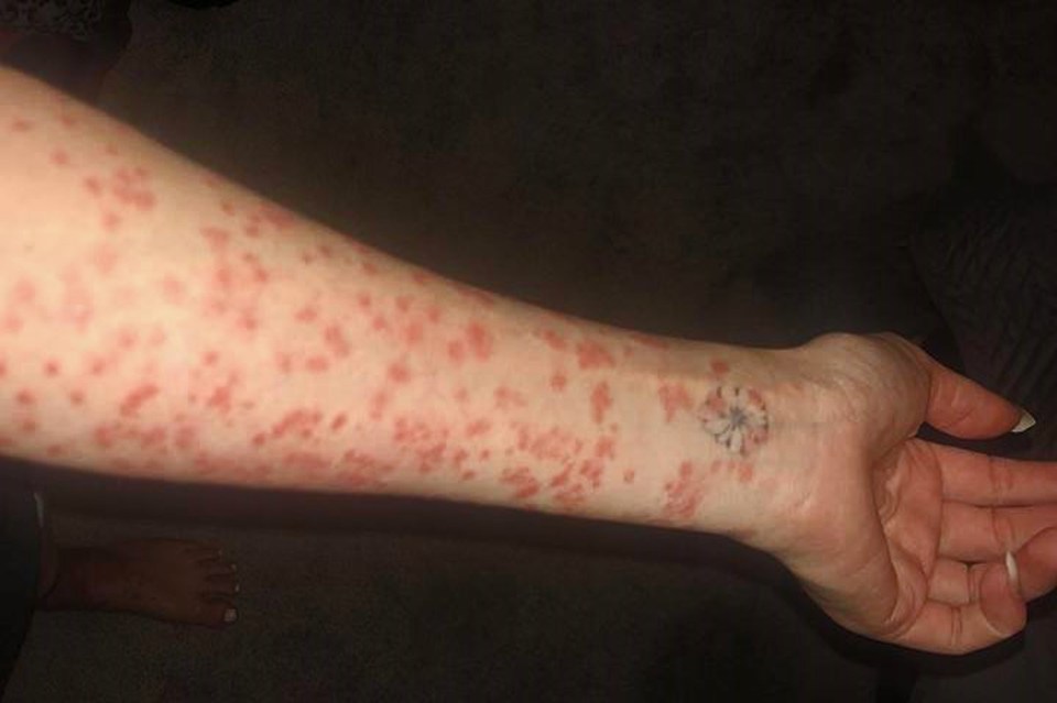  Georgia shows the skin on her arm which is covered in red, flaky blotches