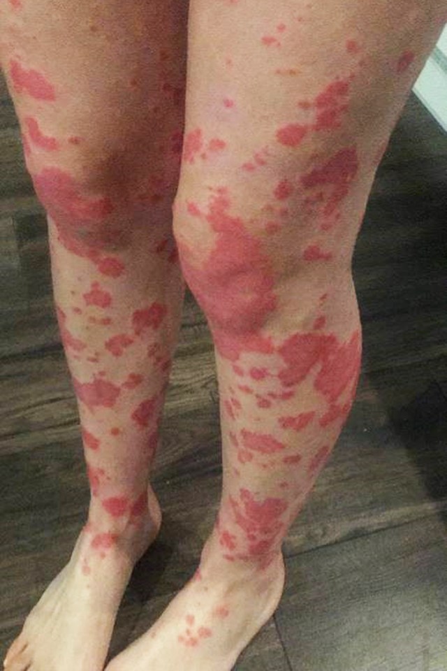  Her legs pictured during a bad psoriasis flare up